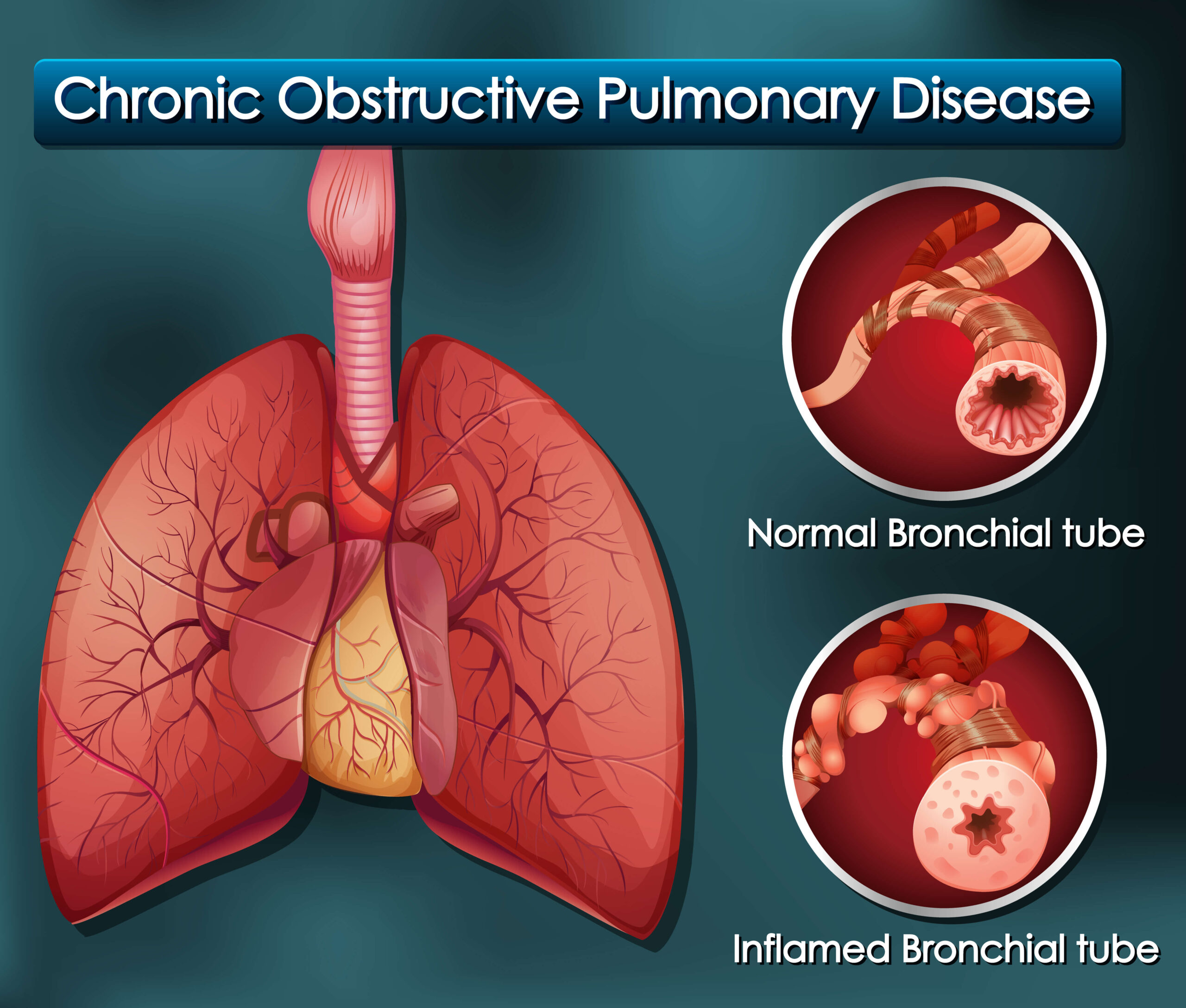 What are symptoms for COPD