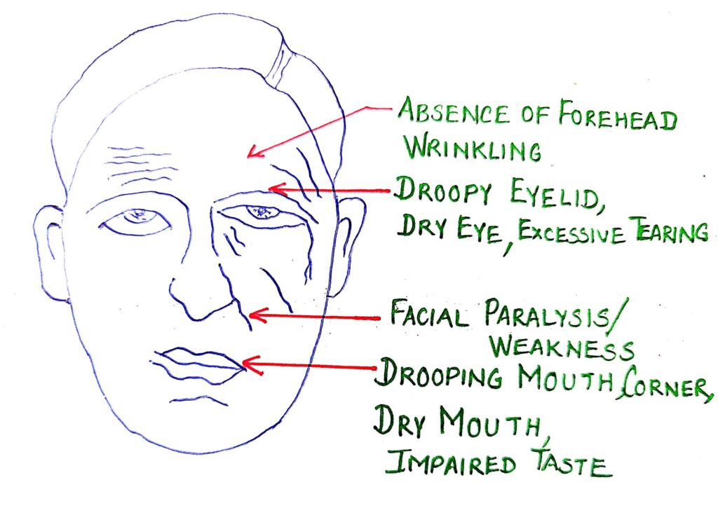 What are causes of Bell's Palsy