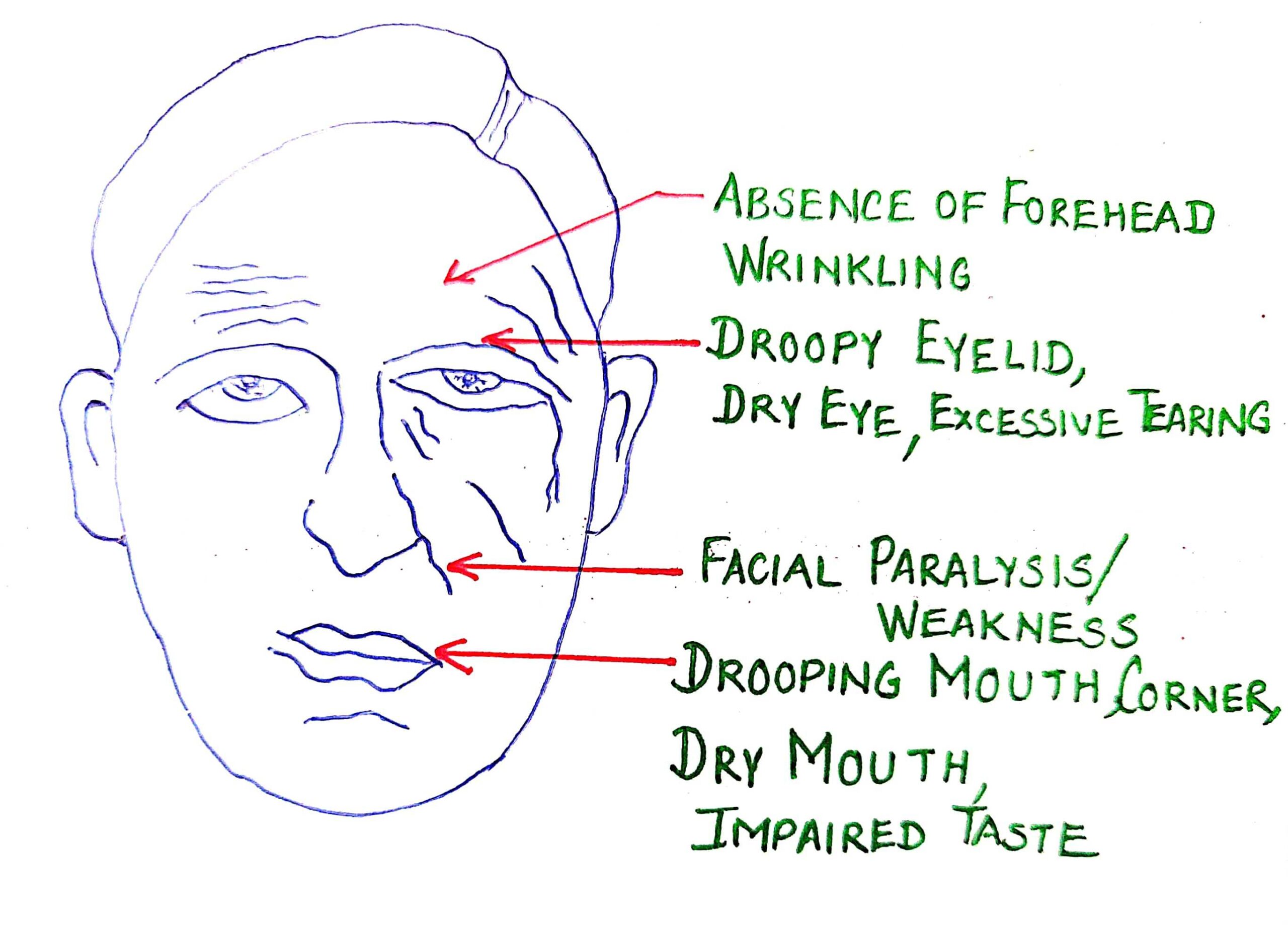 What are causes of Bell’s Palsy